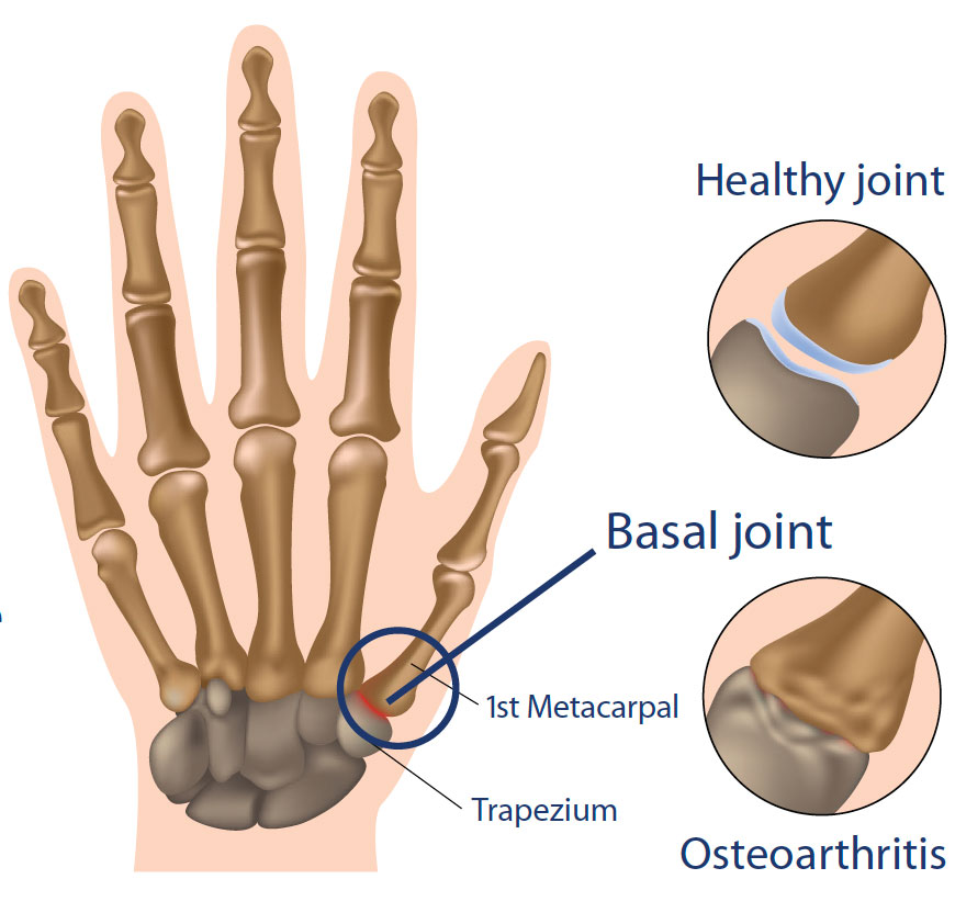 thumb arthritis graphic