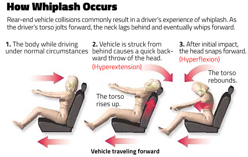 Best way to sleep with whiplash sale