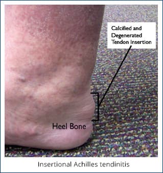 achilles tendon spur