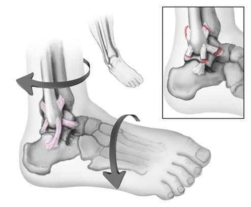Supination Trauma: Rolling your Ankle