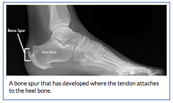 bone spur on back of heel