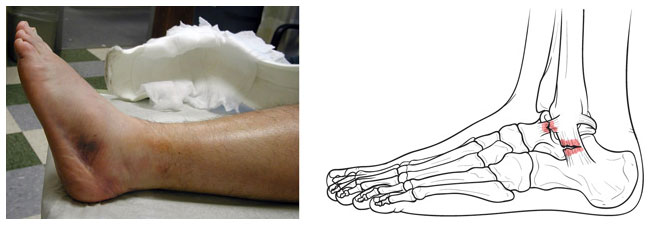 Supination Trauma: Rolling your Ankle