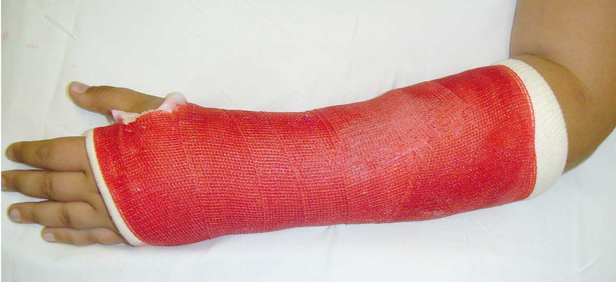 How to take care of your cast  BoulderCentre for Orthopedics & Spine