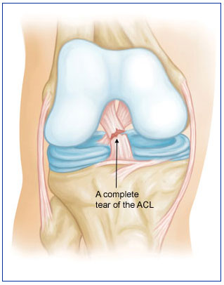 ACL tear diagram