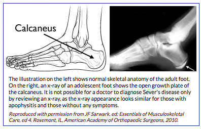 calcaneus