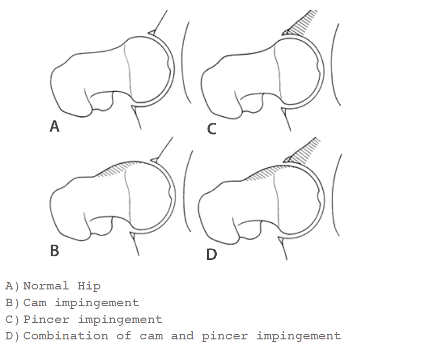 hip impingement image