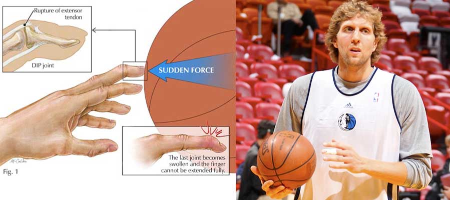 mallet finger injury graphic