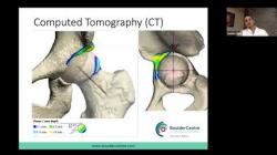 Dr. Austin Chen and Chelsea Alexander Discuss Hip Arthroscopy and Physical Therapy